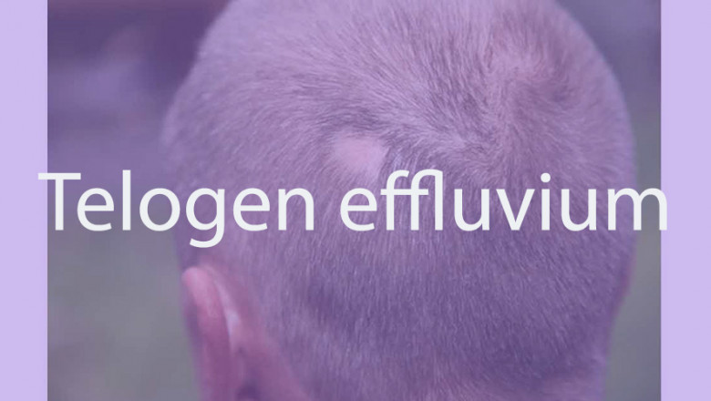 Telogen effluvium