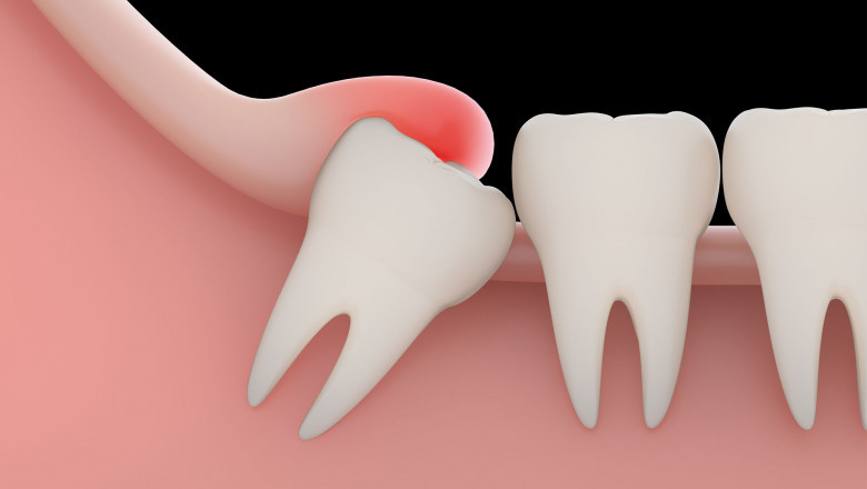 What Should We Do Immediately After Wisdom Teeth Removal Surgery?