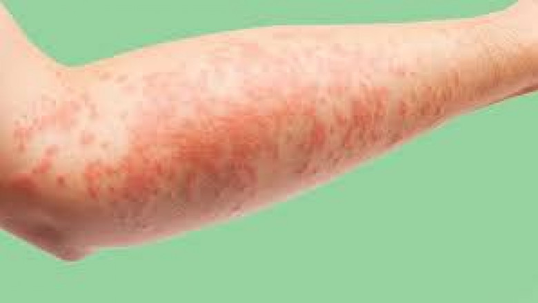 Global Atopic Eczema Treatment Market share and trends and forecast 2022-2027