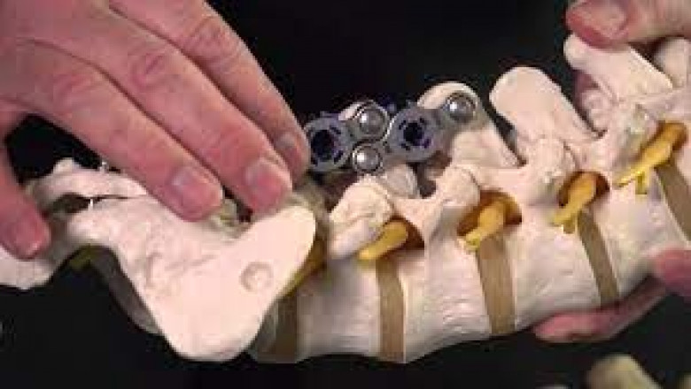 Global Spinal Implants and Devices Market Opportunity Analysis and Industry Forecast 2021–2027