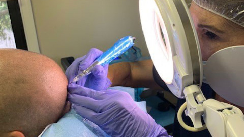 Hair Replication Studio: Camouflaging Your Scars Through Micropigmentation Treatment