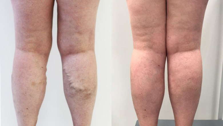 What Things You Should Know During Recovery Of EVLT?