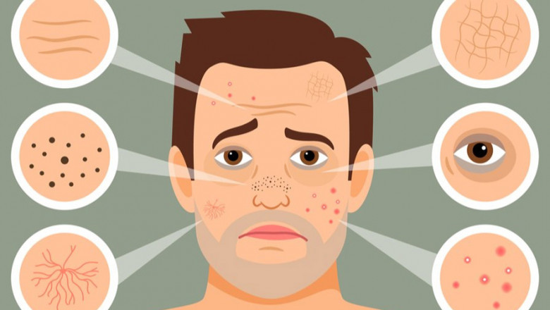 Acne in men