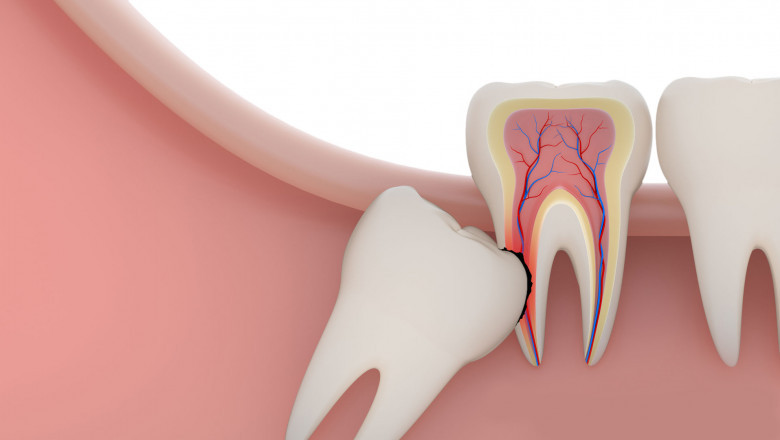 Are There Different Types of Impacted Wisdom Tooth?