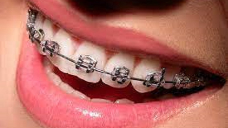 Dental Orthodontics Market Size, Share, Forecast, &amp; Industry Analysis 2028