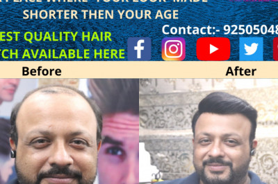 CHOOSE DELHI HAIR FIXING FOR HAIR PATCHES FOR MEN