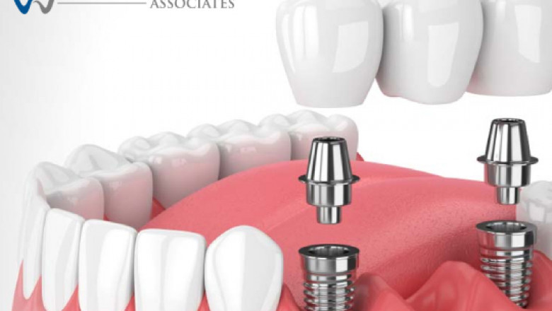 Is Dental Implant Procedure Painful?