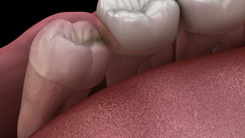 What Is The Procedure Of Wisdom Teeth Extraction?