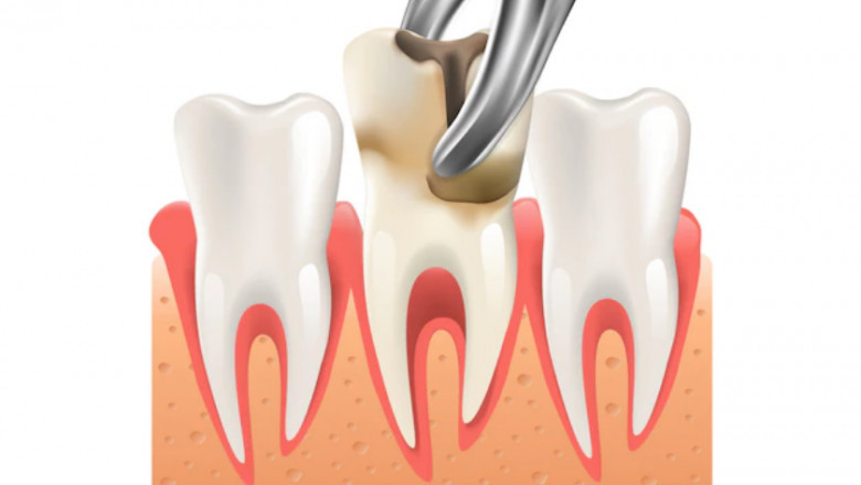 What to eat after wisdom tooth extraction?