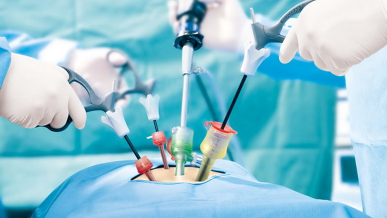 The Critical Role of Laparoscopy in Infertility Treatment