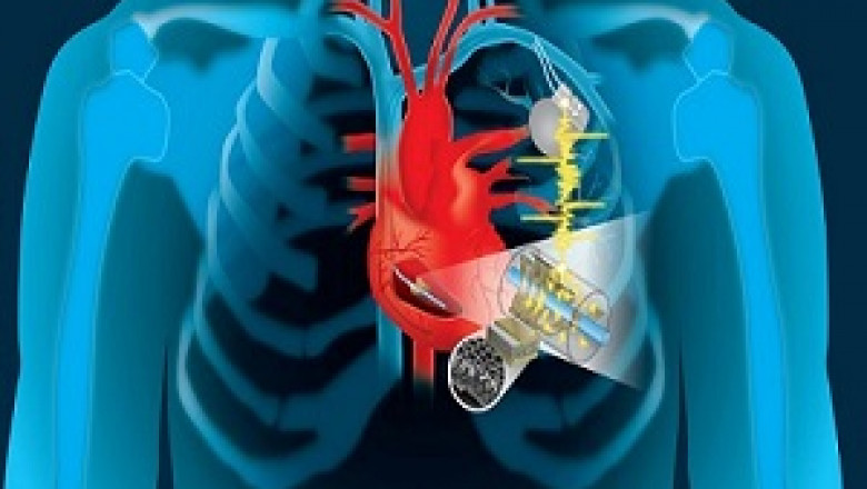 Global Structural Heart Devices Market Size, Share, Trends and Industry Growth Analysis Report to 2028