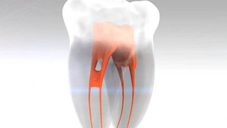 Best Root Canal Treatment - Eternal Smile.