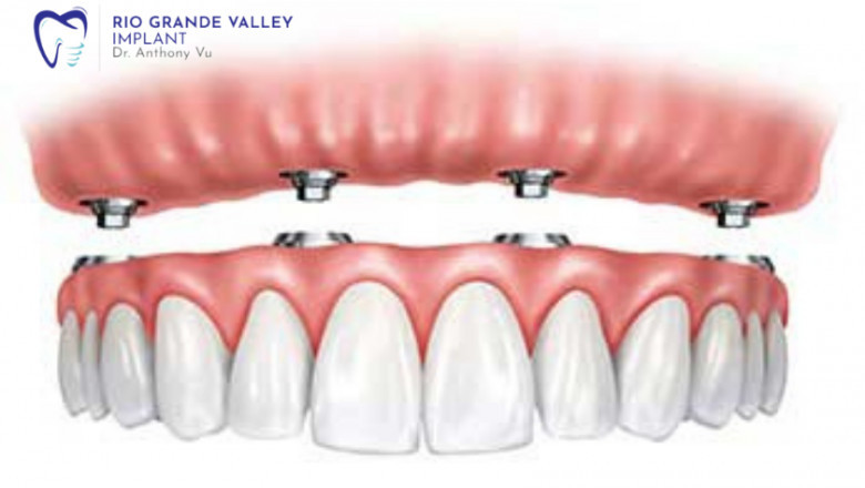 What Are the Benefits of Full Mouth Dental Implants?