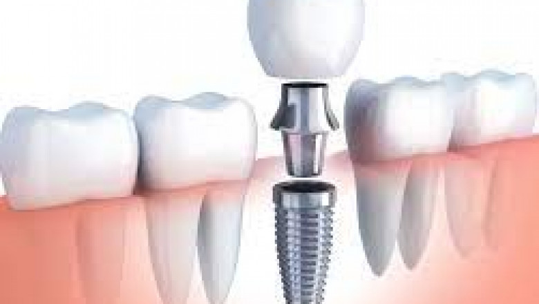 What Do You Know About Wisdom Tooth Extraction?