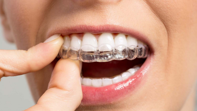 Can You Mention The Benefits Of Invisalign Aligners?
