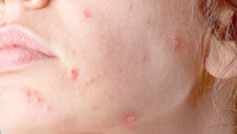 https://www.herbal-care-products.com/blog/10-actinic-keratosis-home-remedies-and-natural-cure/