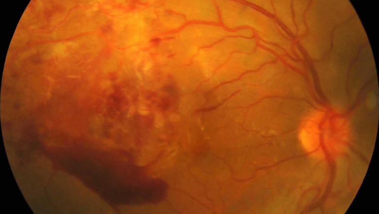 Vasculitis Treatment Market: Global Trends, Share, Size, Growth, Opportunity And Forecast 2022-2028