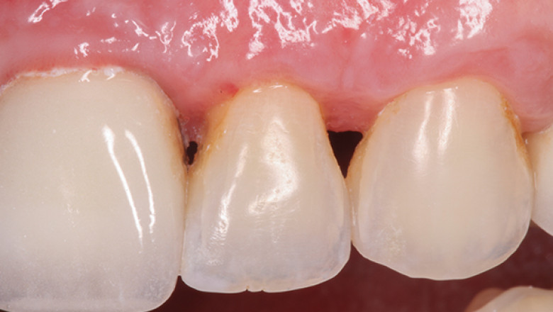 Dental Papilla Loss Treatment