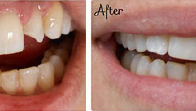 Dental Veneers and Bonding