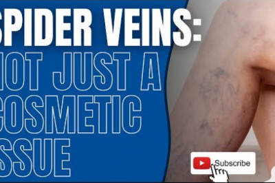Spider Veins: More Than Just A Cosmetic Condition