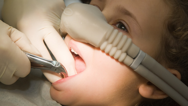 Everything You Need to Know About Nitrous Or Laughing Gas