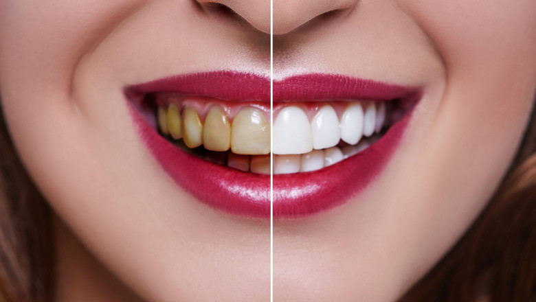 How to Make a Dental Veneers Cost Wise Decision