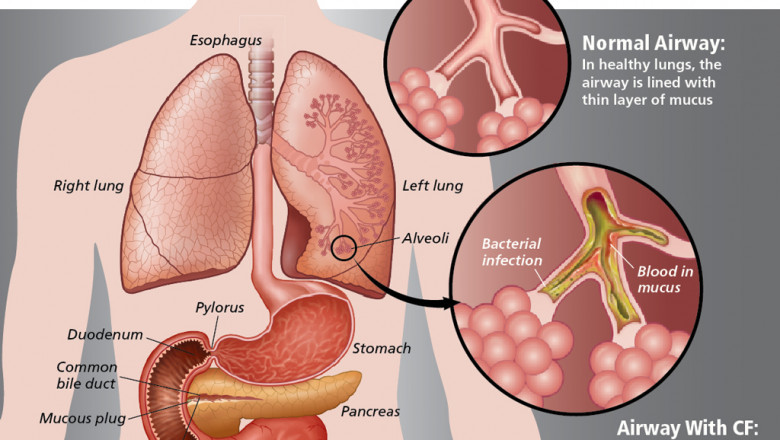 Technological Advancements of Cystic Fibrosis
