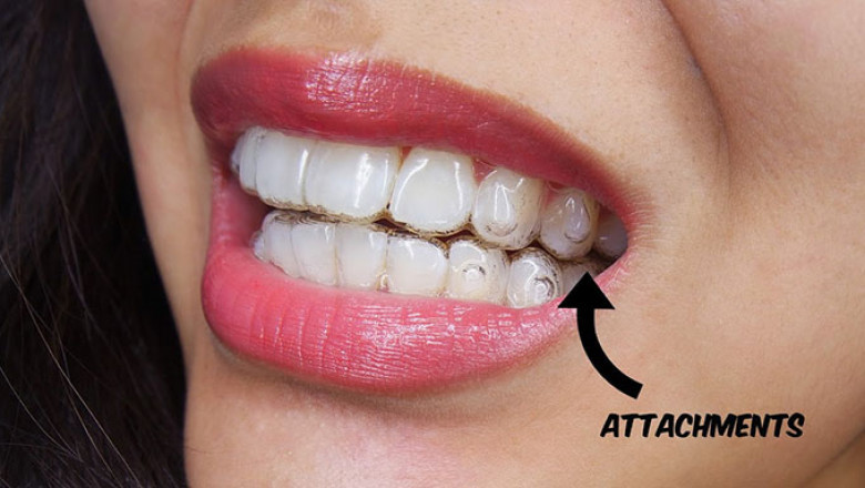 What Are the Benefits of Invisalign for Teens?