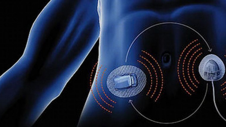 What is Artificial Pancreas Device System (APDS) Market Overview