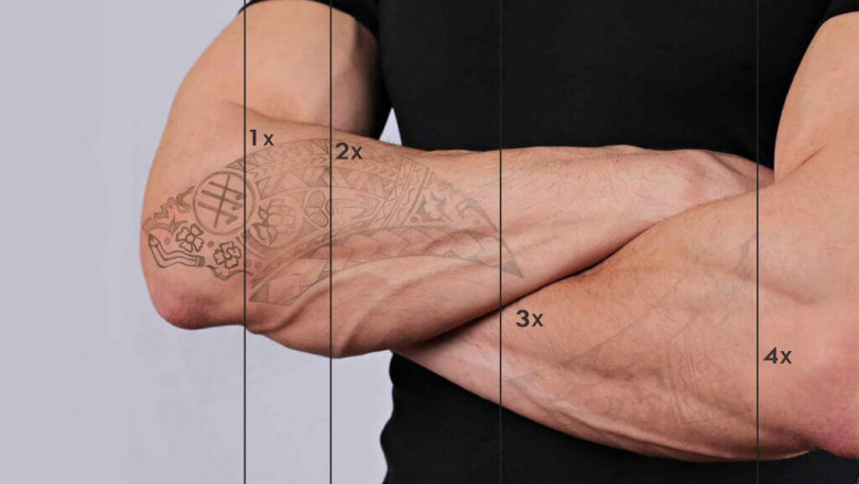 Factors That Influence a Successful Tattoo Removal Treatment in Brisbane, QLD