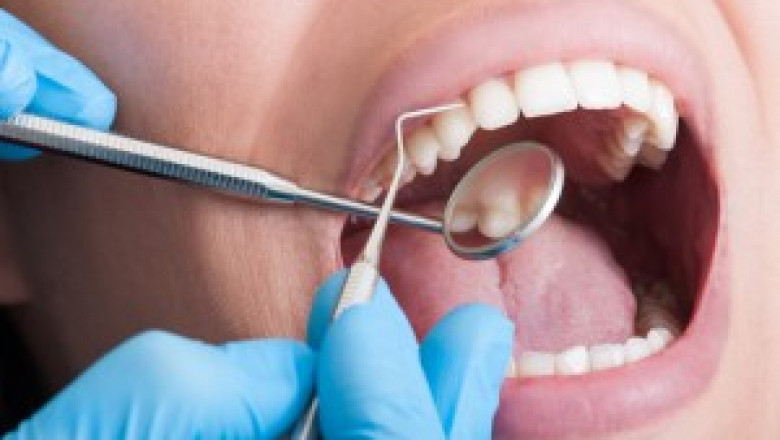 How to Reduce the Cost of a Professional Teeth Cleaning