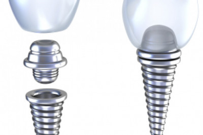 What Are Mouthguards? Why Do We Need Them?