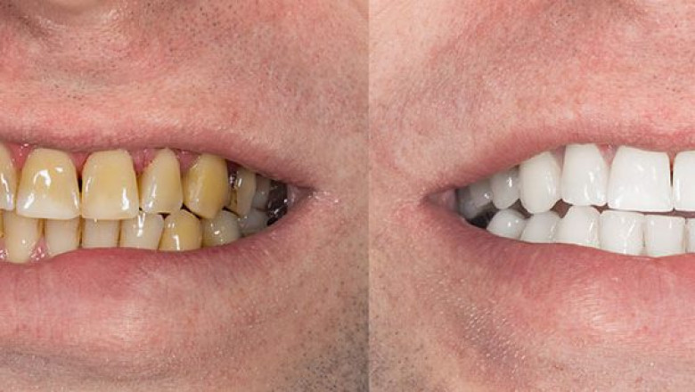 Teeth Whitening Options