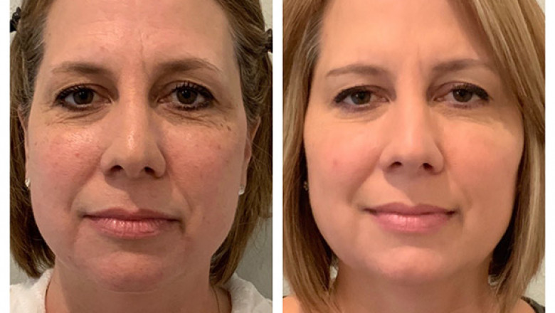 WOULD A LIQUID FACELIFT WORK FOR YOU?