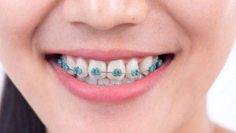 Best Braces for Teeth - Eternal Smile.