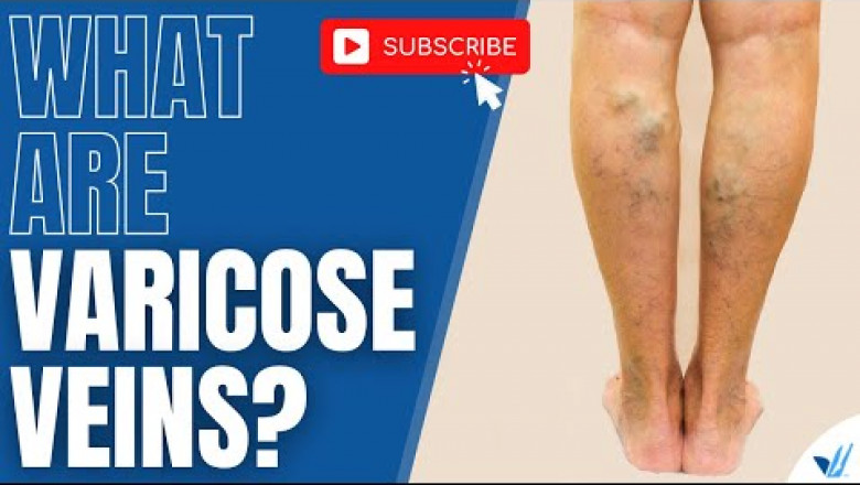Varicose veins are bulging, prominent veins in your legs