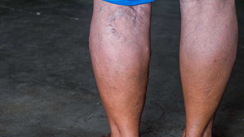 How to choose treatment for varicose veins