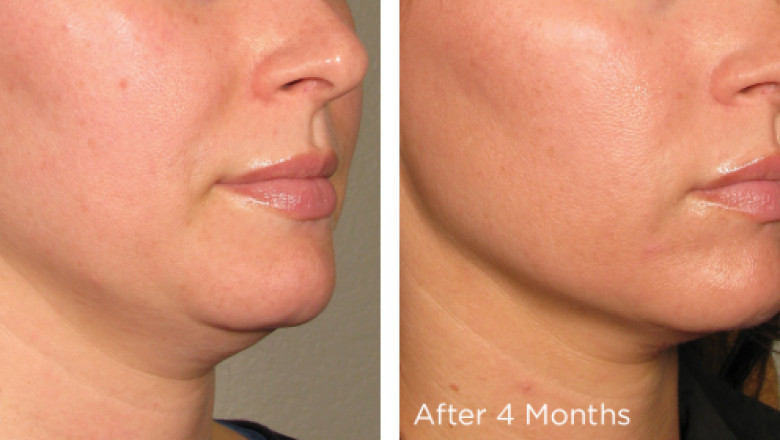 Non-Surgical Face Lifting – Ultherapy