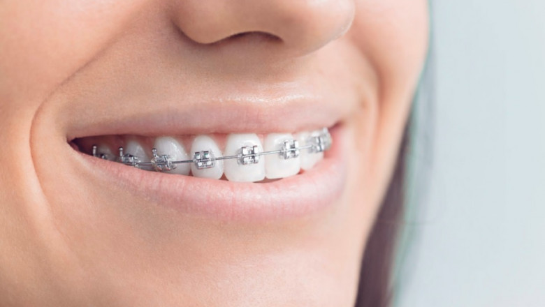Can You Tell Us About The Different Types Of Braces For Adults?