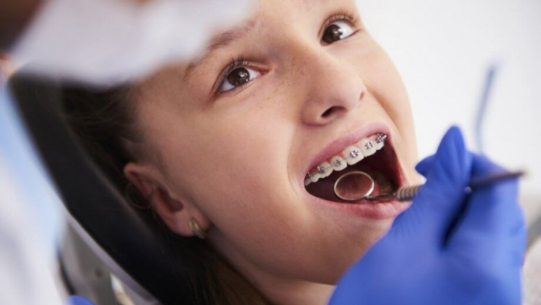 What Is The Cost difference in Lingual Braces In Comparison To Other Braces?