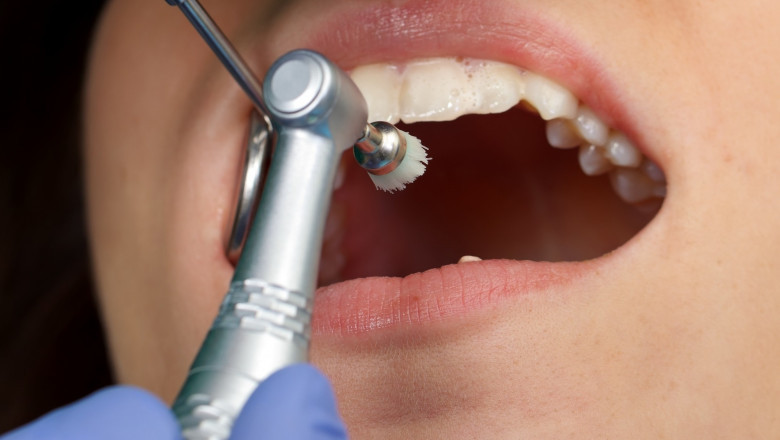 Why Do You Think Deep Dental Cleaning Is Essential?