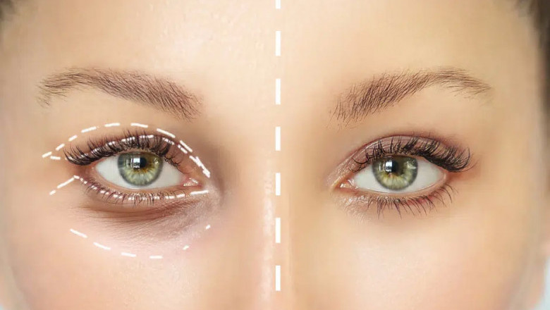 Why you should consider an eyelid lift