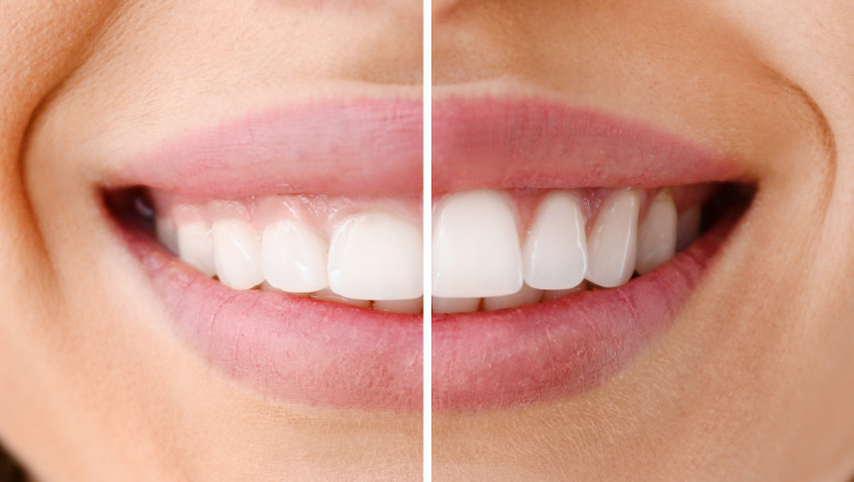 What is the Cost of Laser Gum Recontouring?