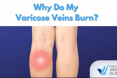 Why Do My Varicose Veins Burn?