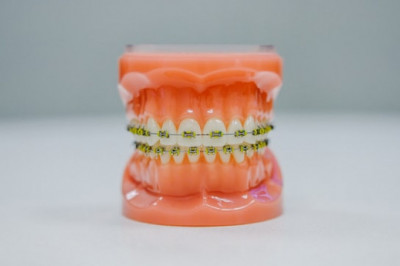 How Long Do Invisalign Treatments Last?