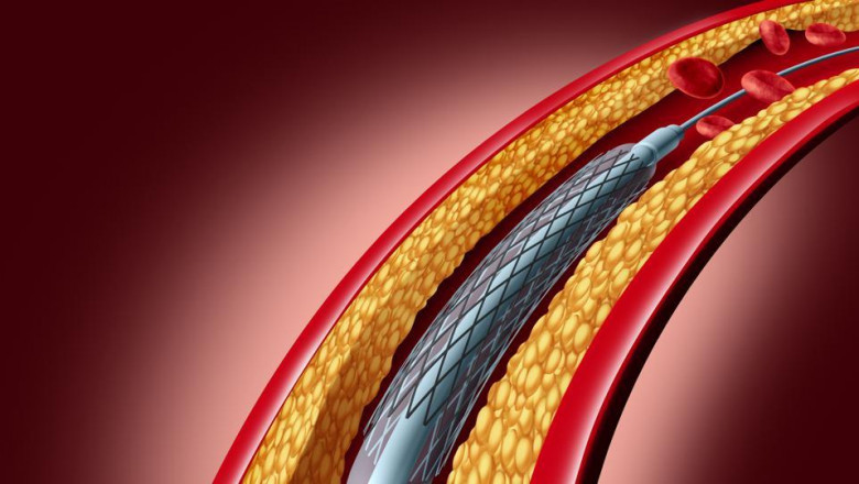 It is expected that the bioabsorbable stent market around the world will grow significantly in the next few years