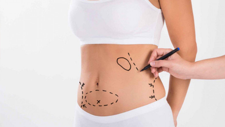 Liposuction Surgery in Delhi – Luxuryaestheticclinic