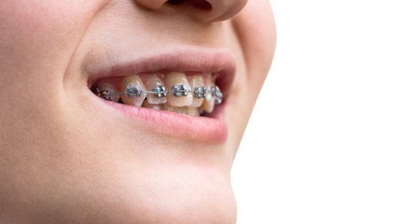 Learn More About Traditional Braces in Carmel, IN