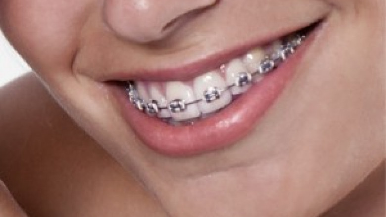 Charlotte Braces Clinic