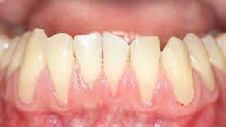 What Are The Vital Facts To Know About LANAP Dental Procedure?